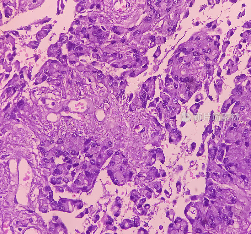 星形细胞瘤，髓内SOL (C5-D3)组织活检。显微照片显示恶性肿瘤卵圆形到细长的细胞，细胞核偏心，嗜酸性细胞。Micovascular增殖。